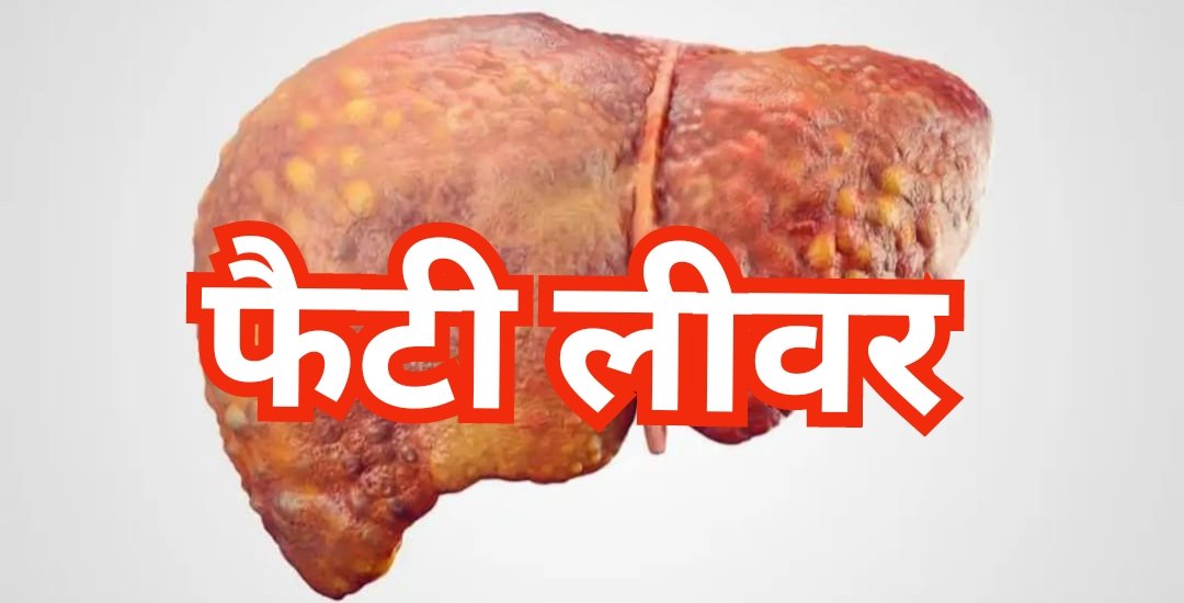 फैटी लीवर की समस्या से कैसे करें अपना बचाव... जानें 